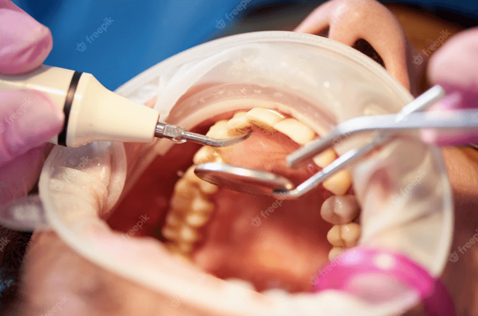 Close-up photo of a person's mouth during a dental examination, with a dentist using mirror instruments to examine tartar buildup.